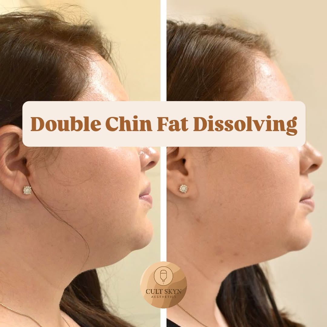 Double Chin Fat Dissolving