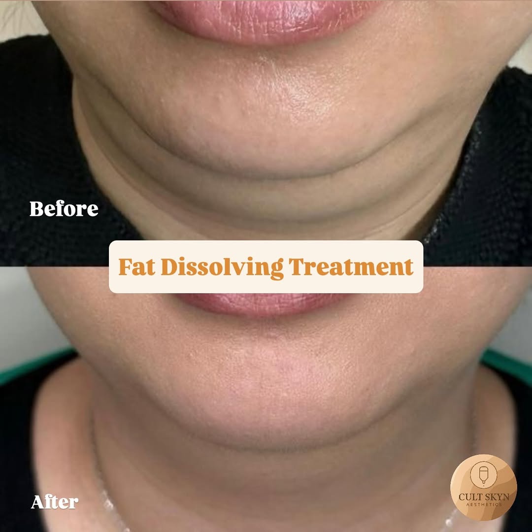 Fat Dissolving Treatment