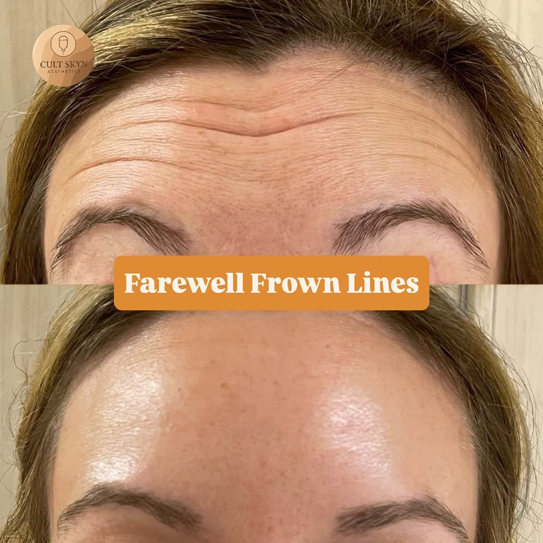 Anti-Wrinkle — Frown Lines