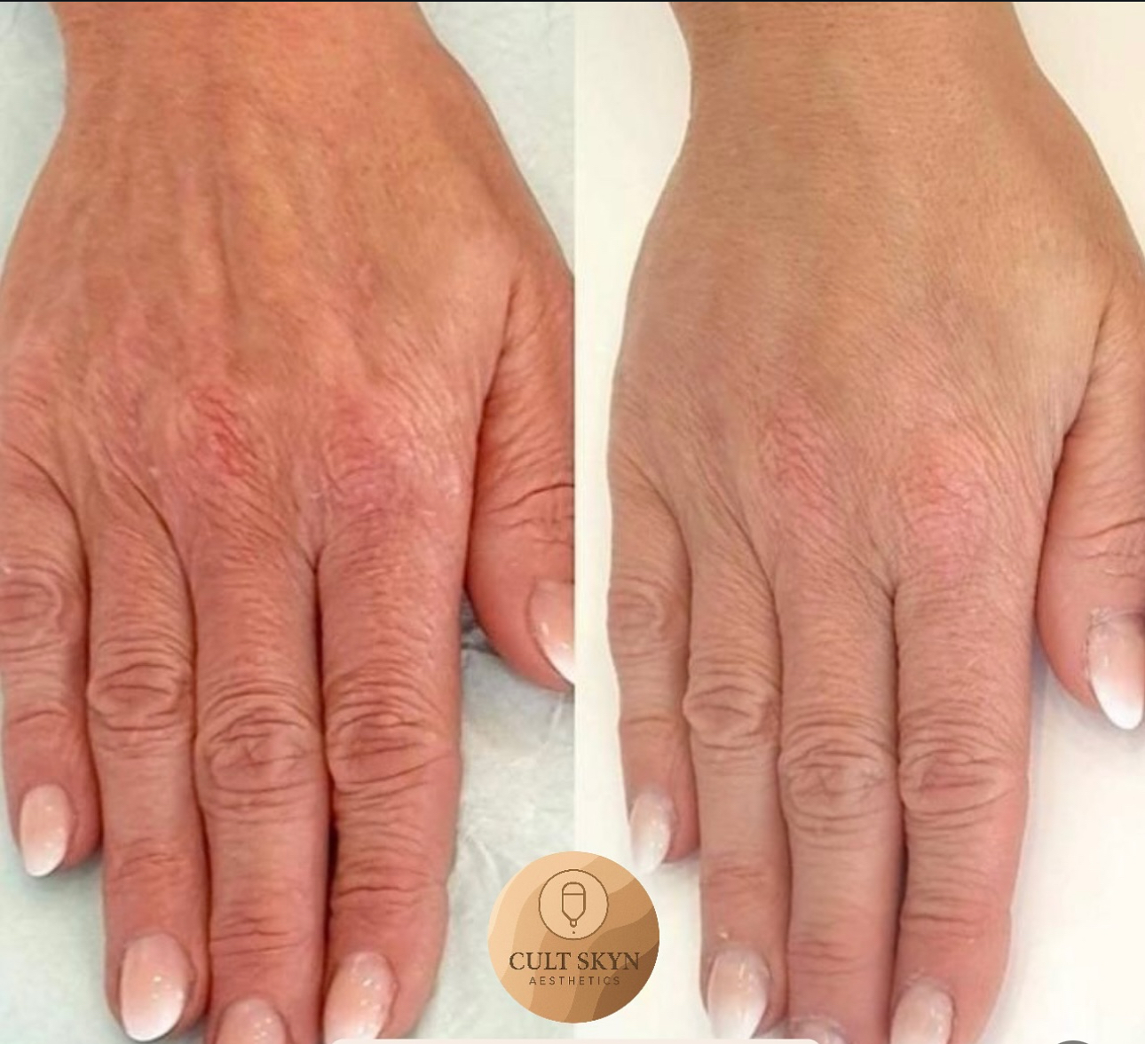Skin Booster — Hands