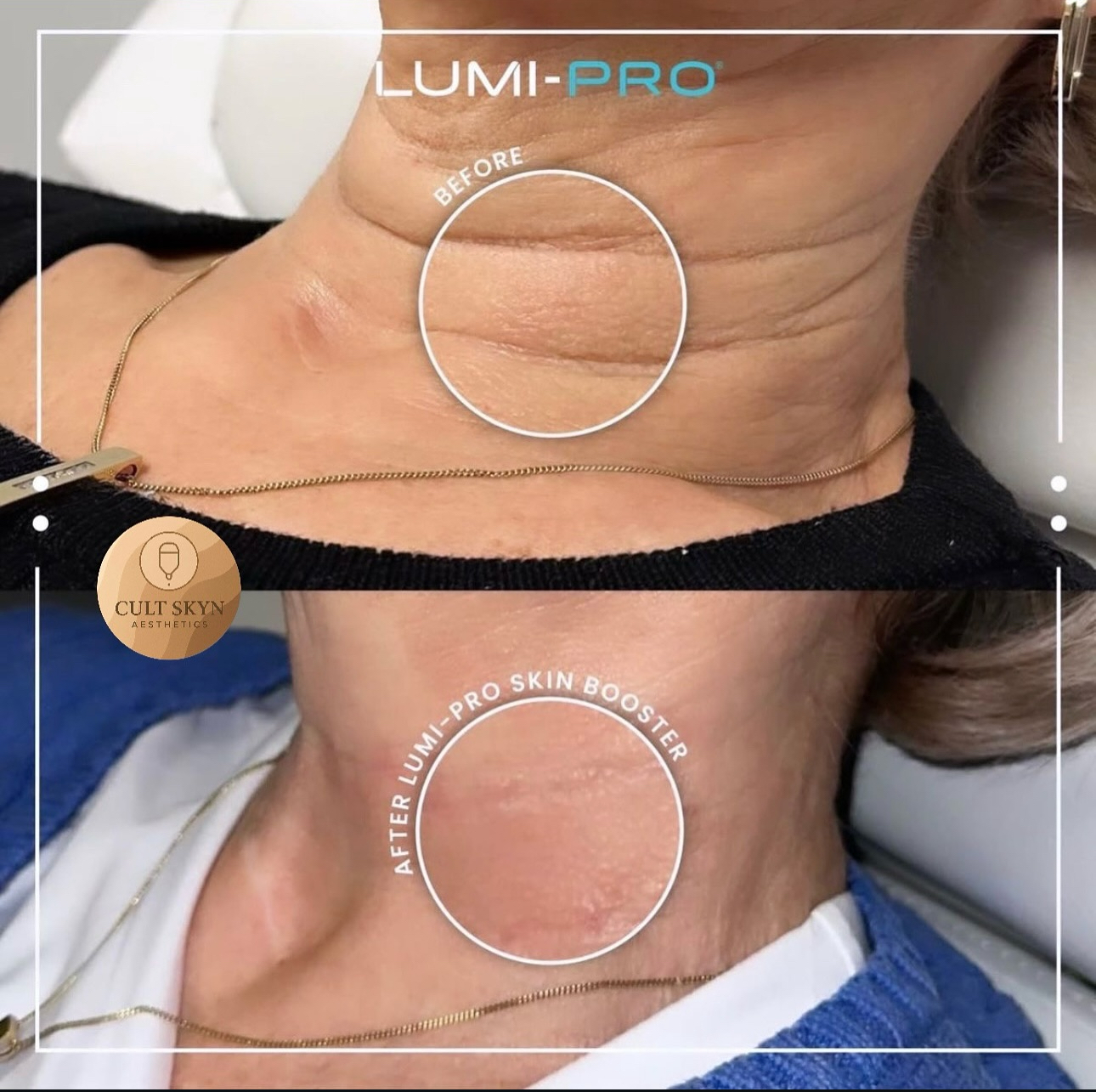 Lumi-Pro Skin Booster