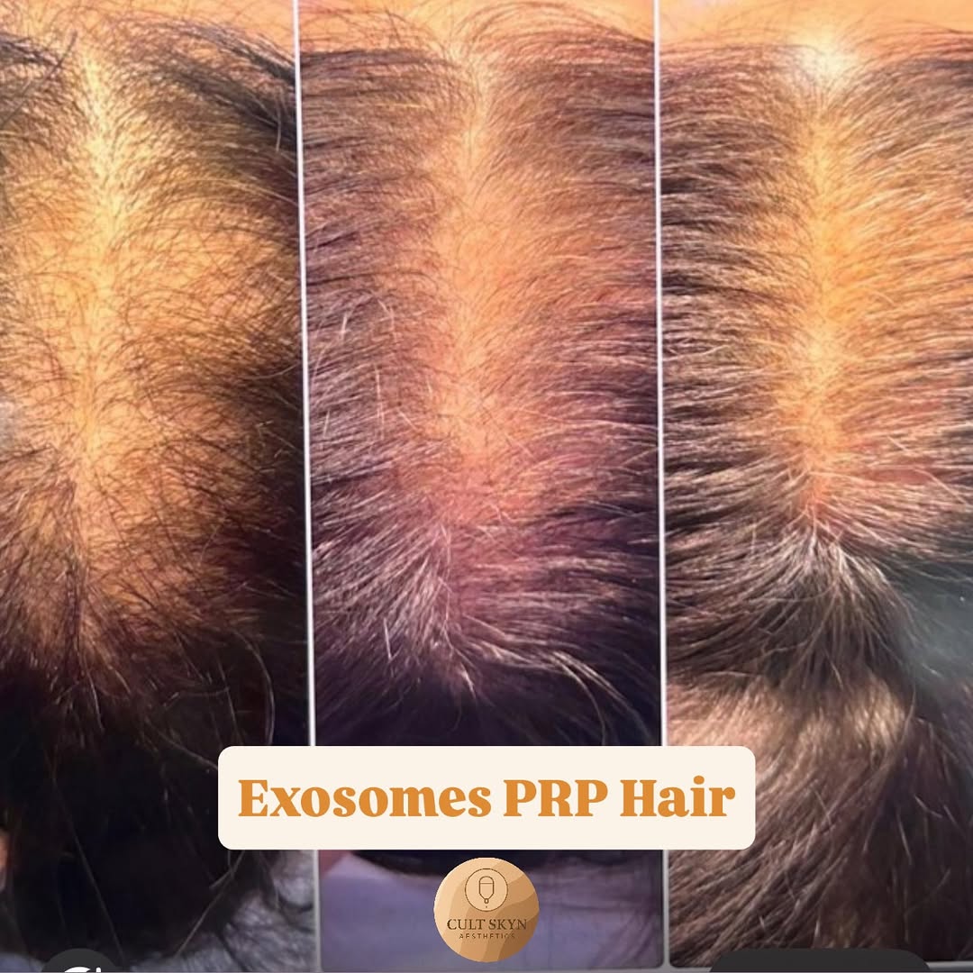 Exosomes PRP Hair